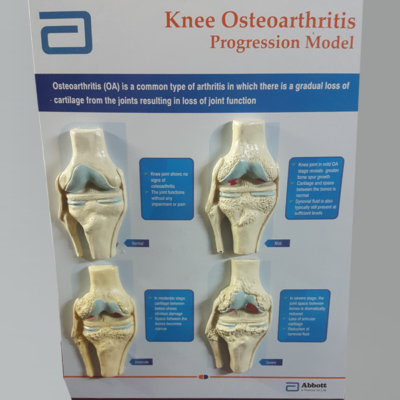 Knee osteoarthritis Patient Education Model - Aceconcepts