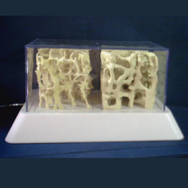 osteoporosis-Bone-comparison